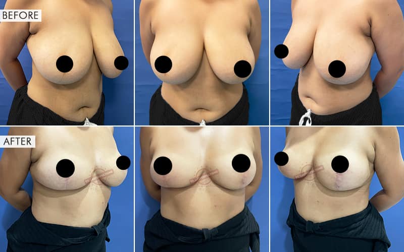 Breast Reduction Before and After result