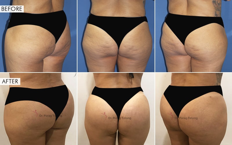 Butt Augmentation Before and After result