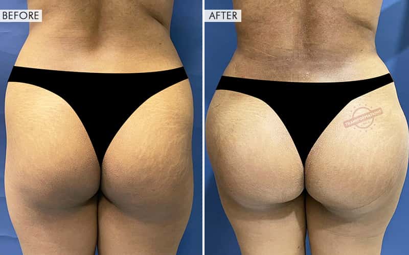 Butt Augmentation Before and After result