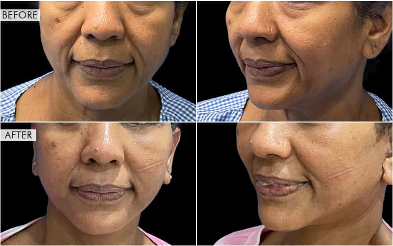 Face Lifting Before and After result