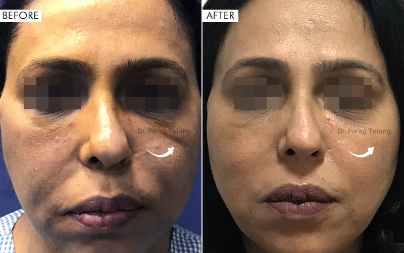 Facelifting with APTOS Before and After result
