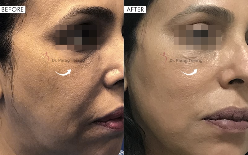 Facelifting with APTOS Before and After result