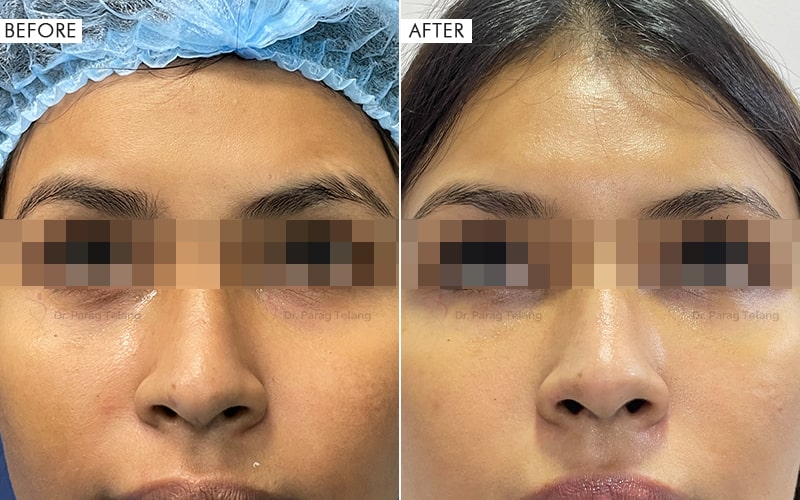 Fat Injection for Under Eye Before and After result