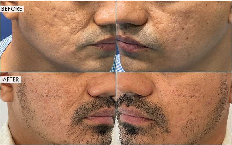 Fat Injection Before and After result