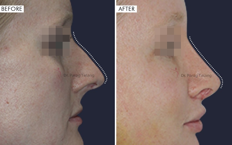 Rhinoplasty Surgery Before and After result