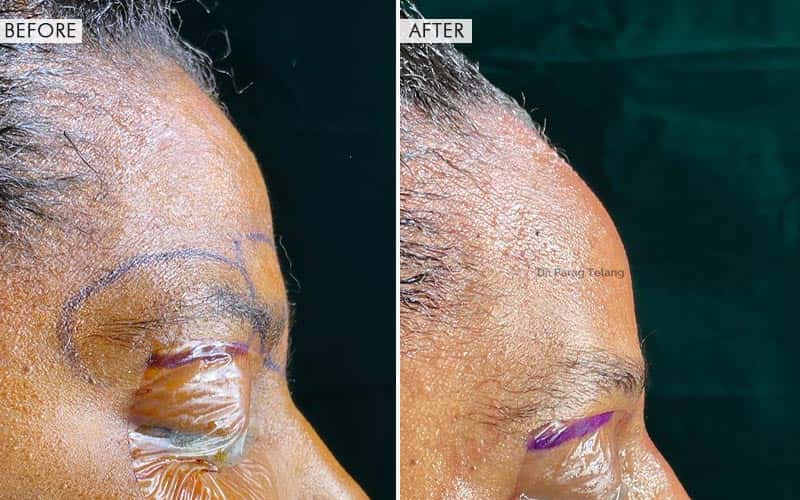 Type-3 Forehead Contouring (Brow Bone Reduction)