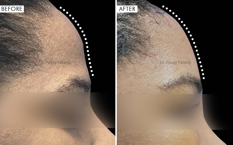 Type-3 Forehead Contouring (Brow Bone Reduction)