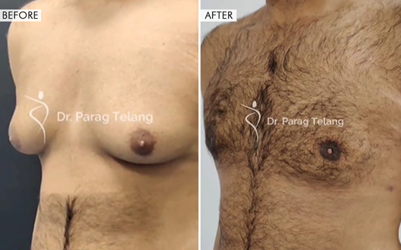 Gynecomastia Before and After result