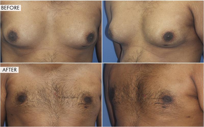 Gynecomastia Before and After result