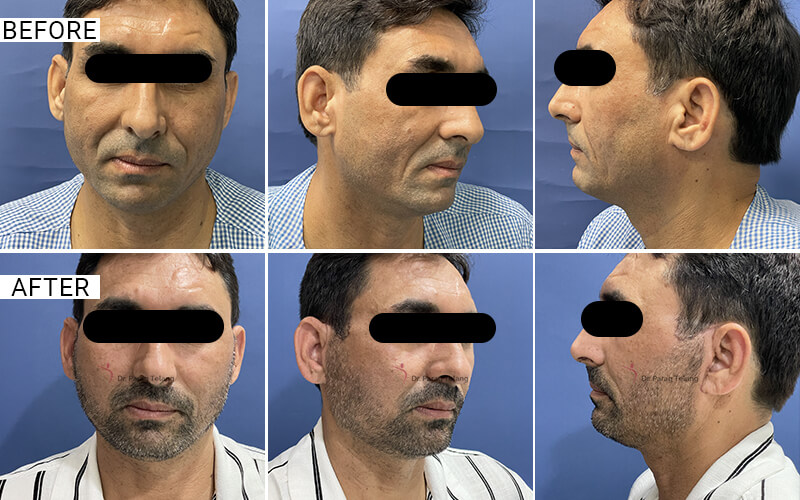Facelift & Necklift Surgery