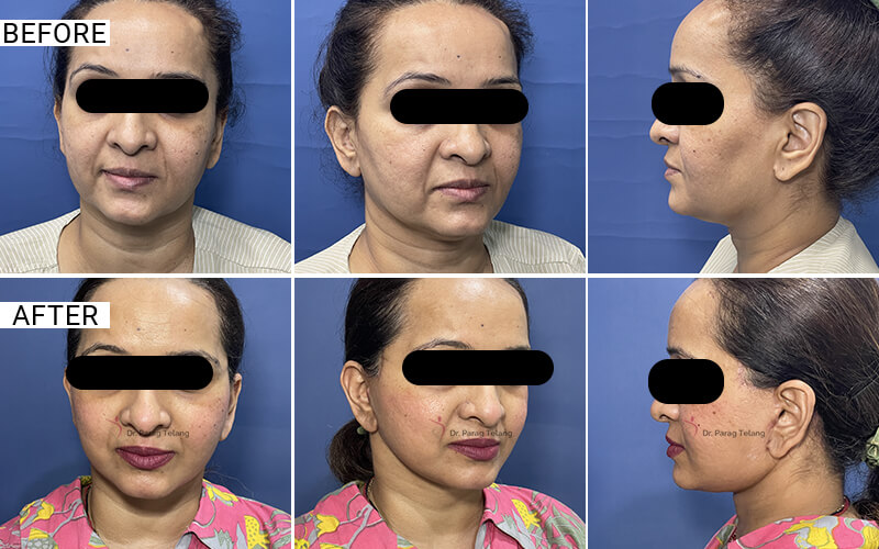 Facelift & Necklift Surgery