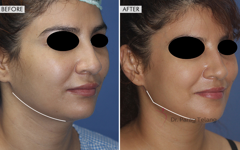 Jaw Contouring Before and After result