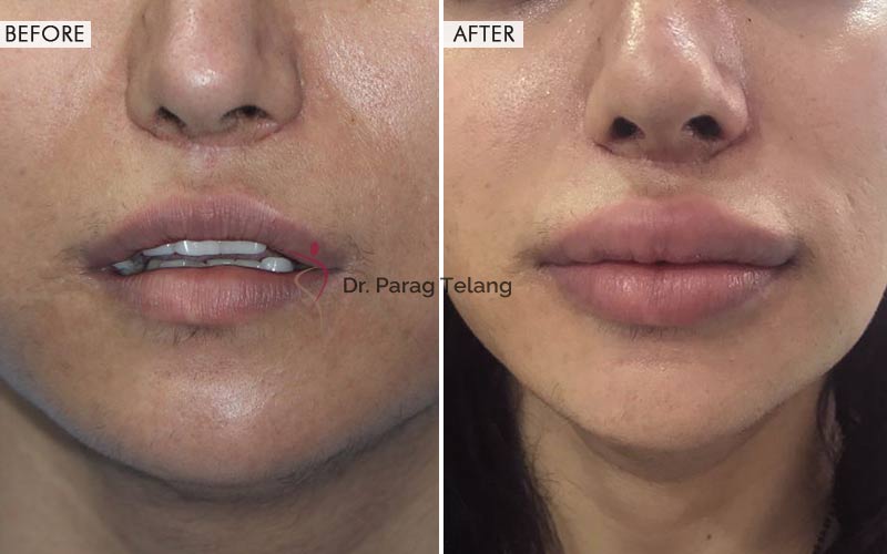 Lip Augmentation Before and After result