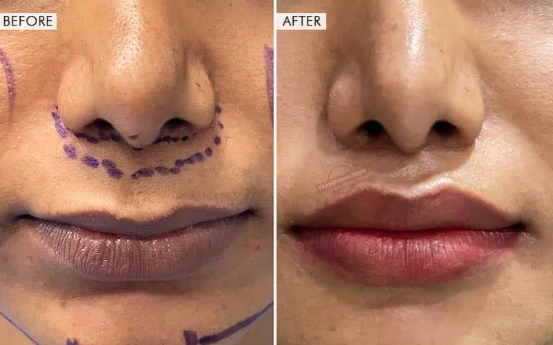 Lip Lift Surgery Before and After result