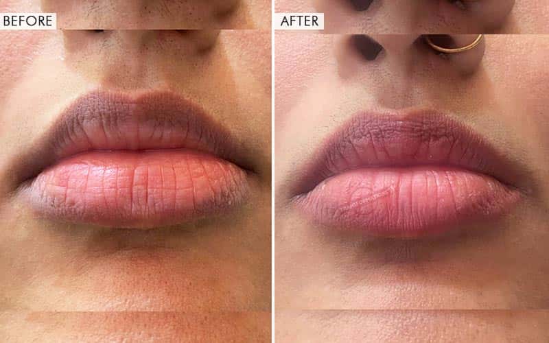 Lip Micropigmentation Before and After result
