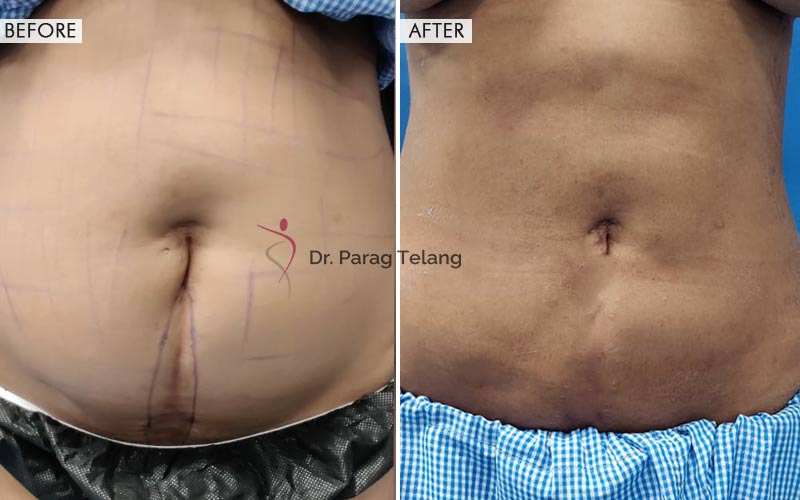 liposuction results before and after