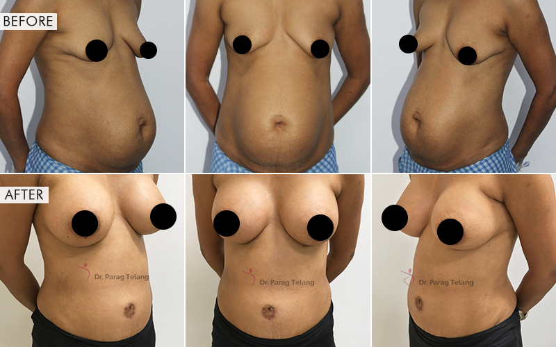 Mommy Makeover Before and After result