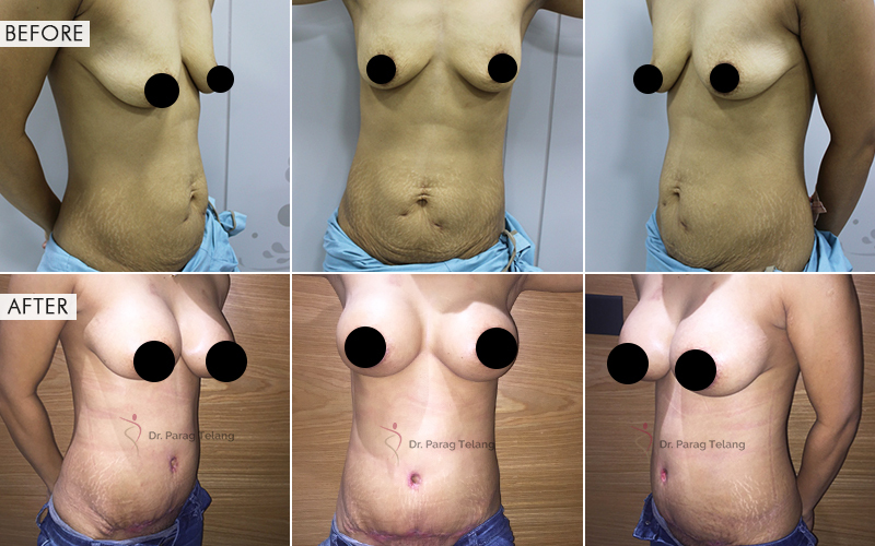 Mommy Makeover Before and After result