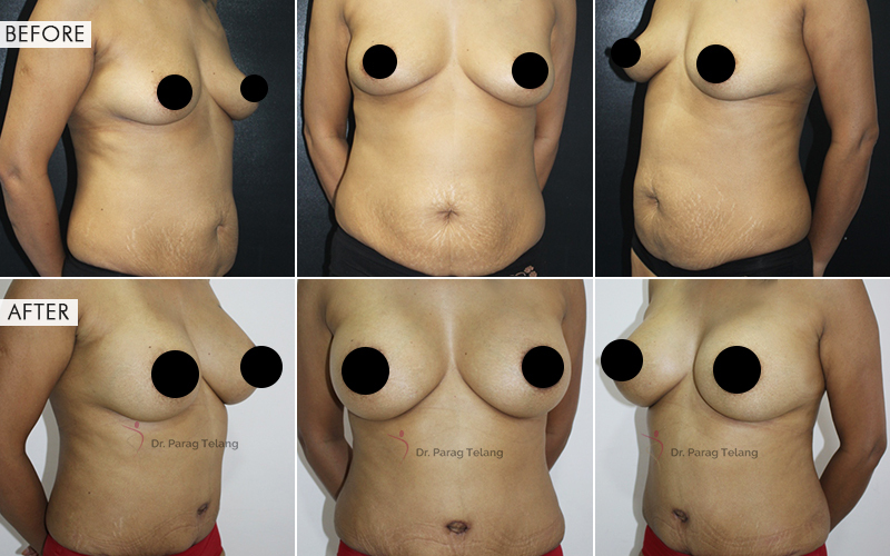 Mommy Makeover Before and After result