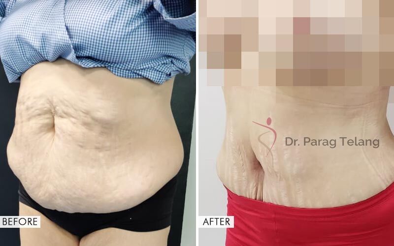Mommy Makeover Before and After result
