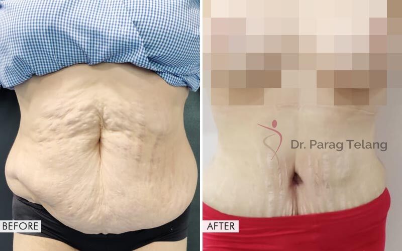Mommy Makeover Before and After result