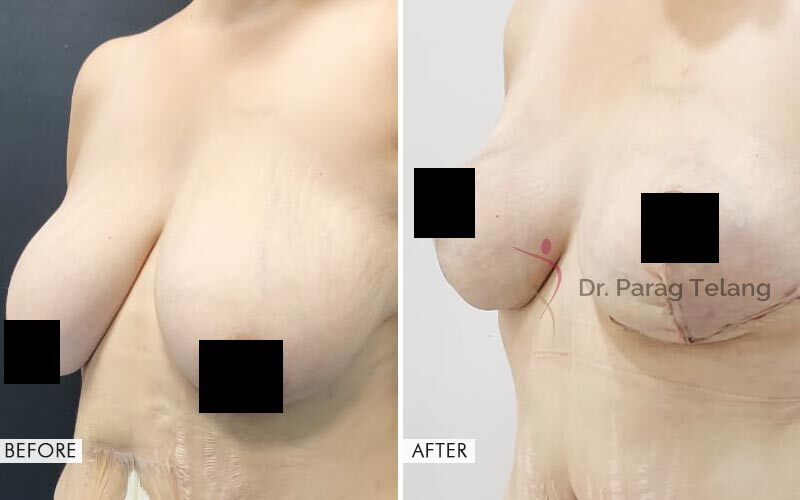 Mommy Makeover Before and After result
