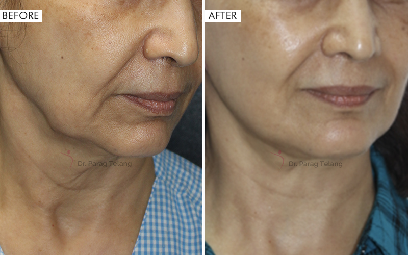 Jaw & Neck Contouring Before and After result