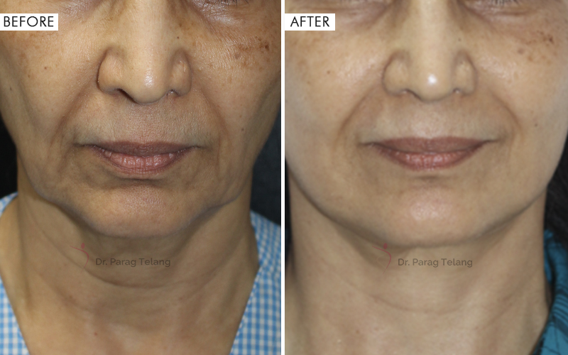Jaw & Neck Contouring Before and After result