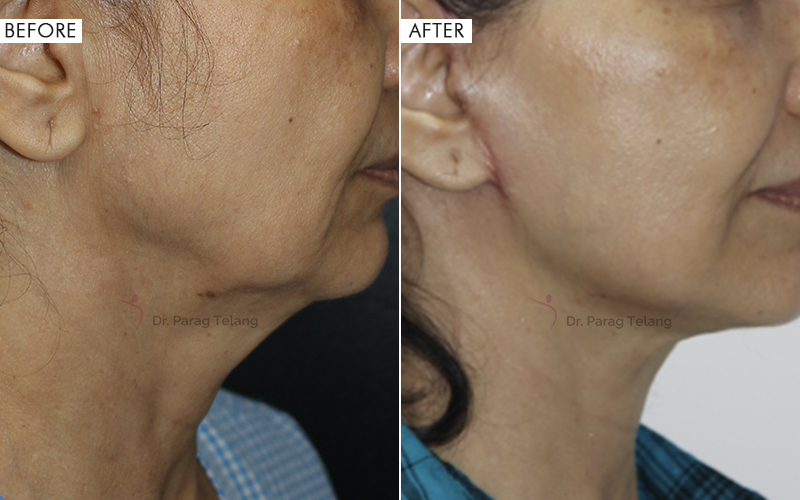 Jaw & Neck Contouring Before and After result