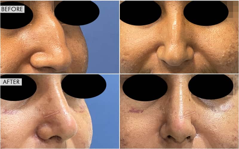 Rhinoplasty Surgery Before and After result
