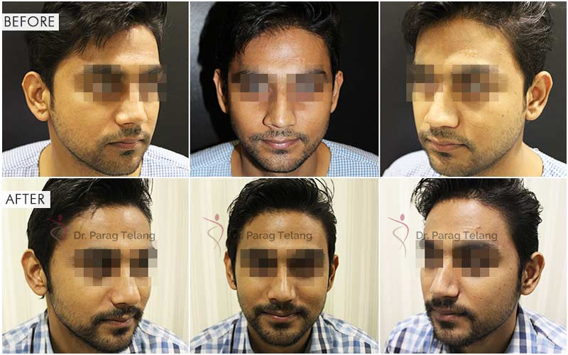 rhinoplasty surgery before and after