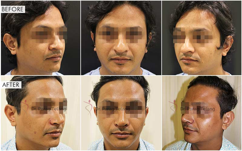 rhinoplasty surgery before and after