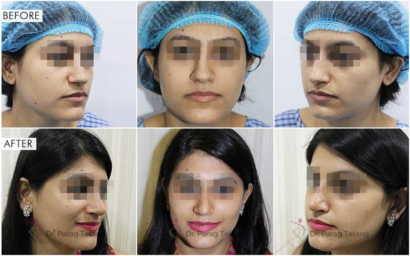 Rhinoplasty surgery Before After
