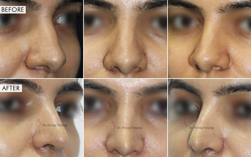 Rhinoplasty Before and After result