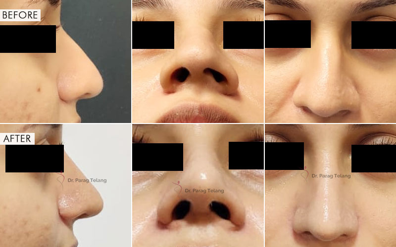 Rhinoplasty Before and After result