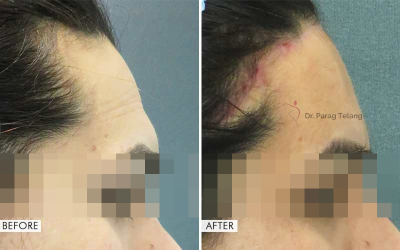 Forehead Contouring Before and After