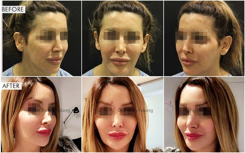 V-line Jaw Surgery Before After