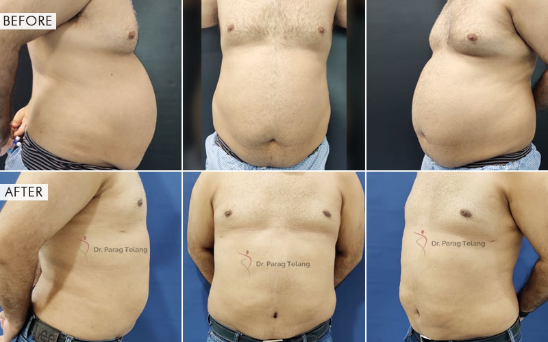 Liposuction Before and After result