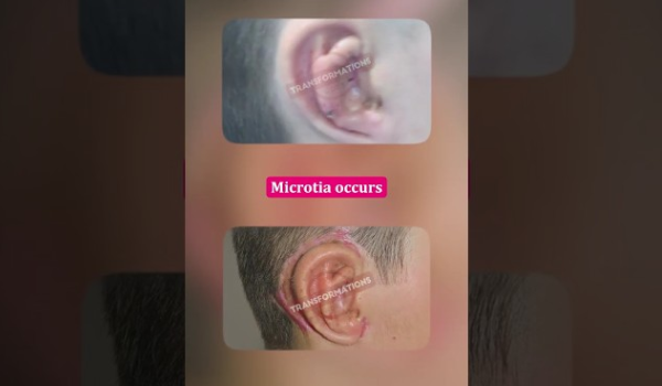 Most Ear Reconstruction Patients Need This #earsurgery #microtia #drparagtelang